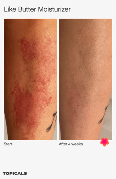topicals like butter moisturizer